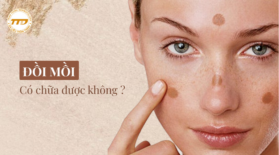 đồi mồi có chữa được không