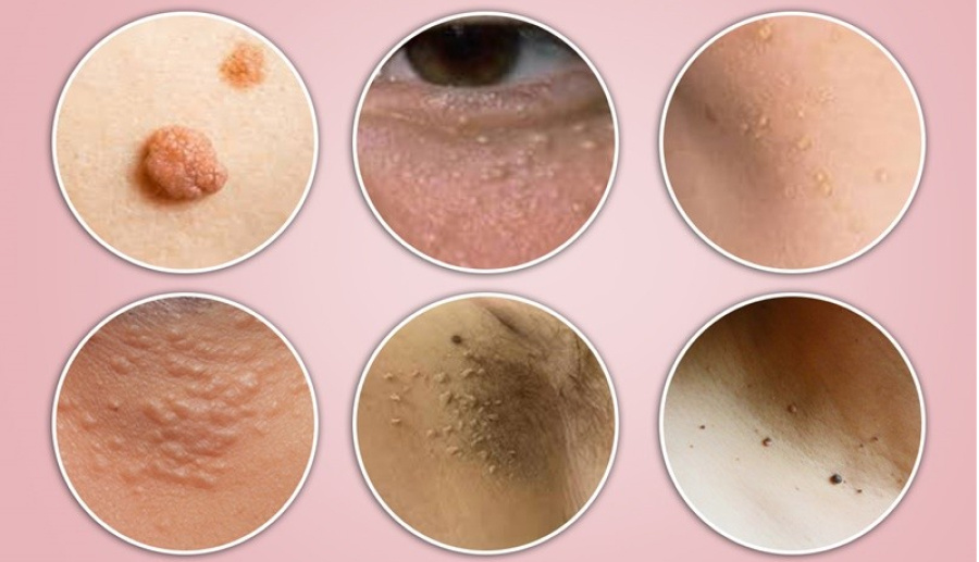 Một số vị trí mọc mụn