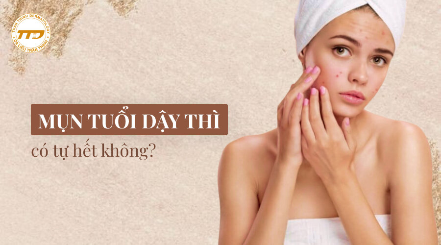 mụn tuổi dậy thì có tự hết không