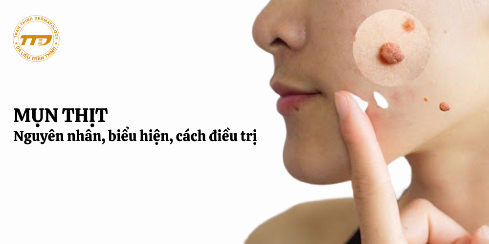 nguyên nhân, biểu hiện, cách điều trị mụn thịt