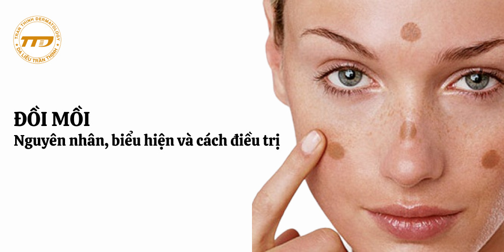 Đồi mồi: nguyên nhân, biểu hiện và cách điều trị