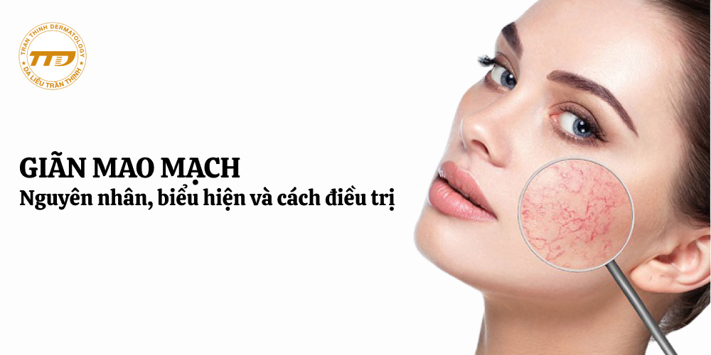 Giãn mao mạch: nguyên nhân, biểu hiện và cách điều trị