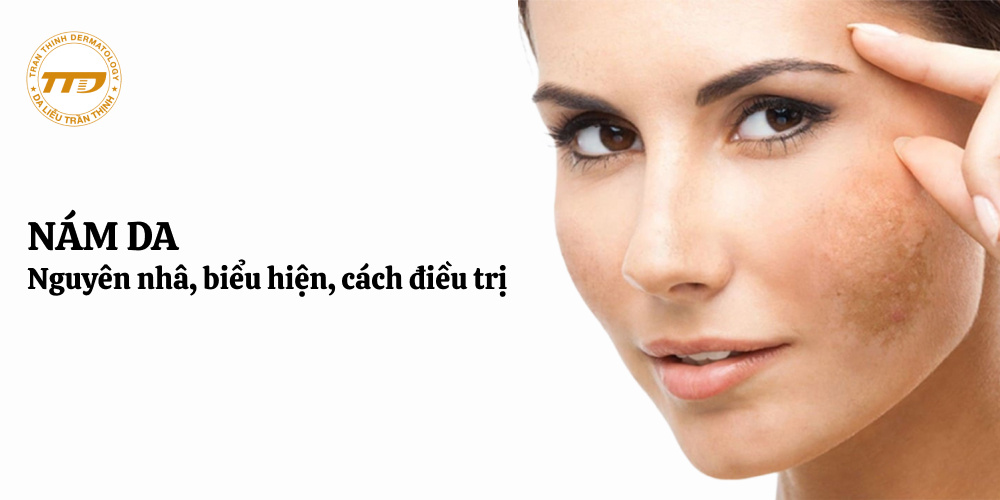 nguyên nhân, biểu hiện, điều trị nám da