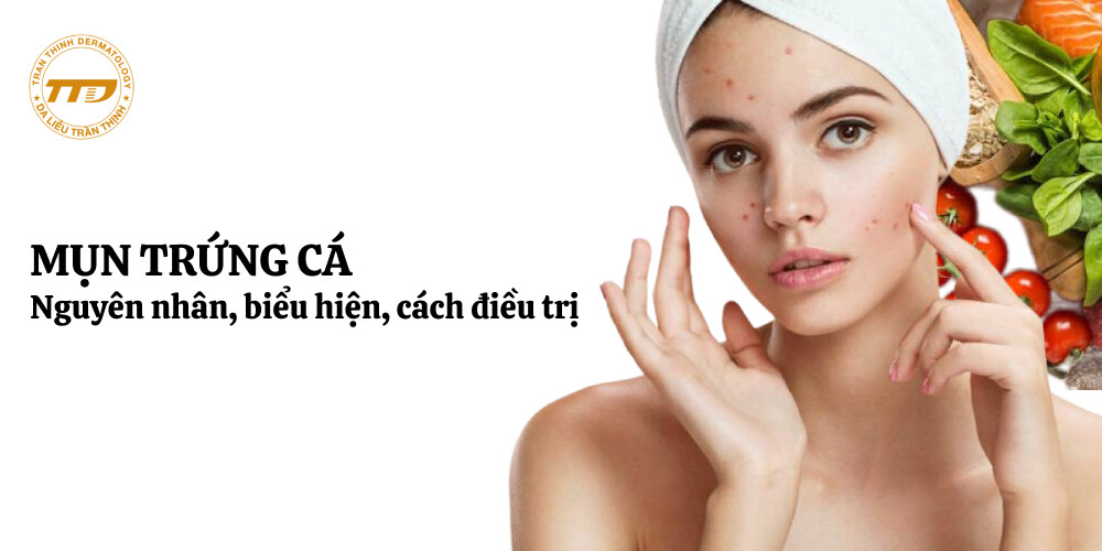 nguyên nhân, biểu hiện và điều trị mụn trứng cá
