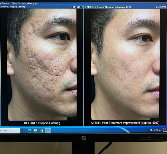 Kết quả điều trị sẹo rỗ lâu năm