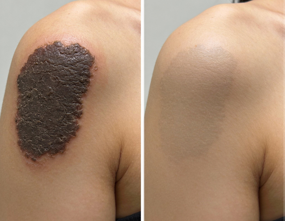 Kết quả điều trị bớt sùi Nevus Verrucosus