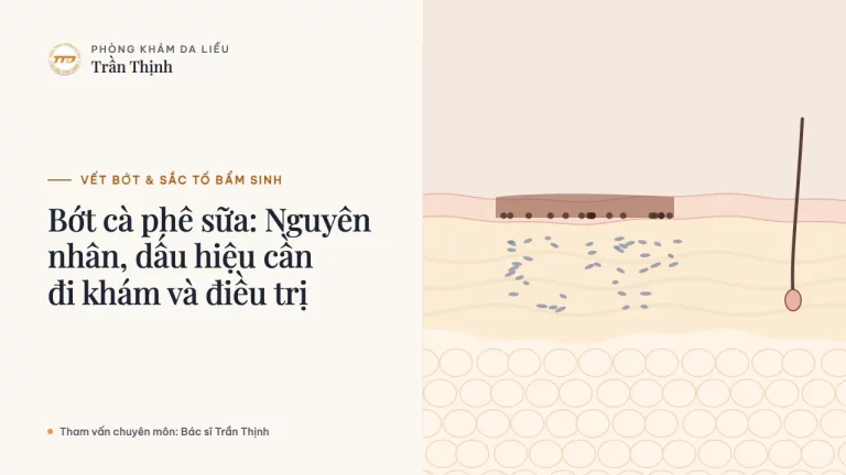 Bớt cà phê sữa: Nguyên nhân, dấu hiệu cần đi khám và điều trị