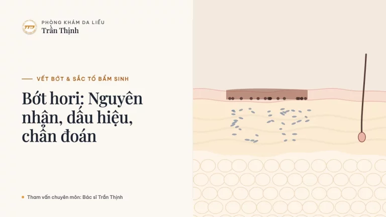 Bớt hori: Nguyên nhân, dấu hiệu, chẩn đoán