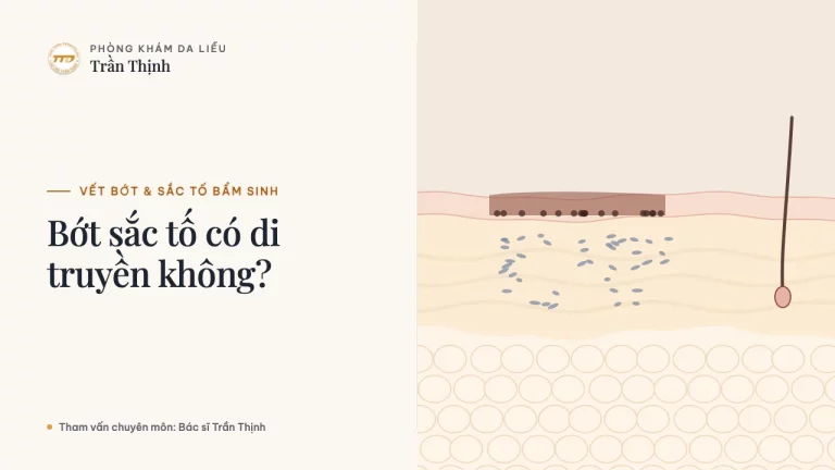 Bớt sắc tố có di truyền không?