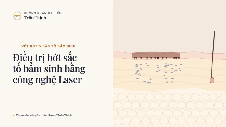 Điều trị bớt sắc tố bẩm sinh bằng công nghệ Laser