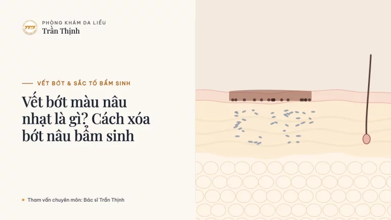 Vết bớt màu nâu nhạt là gì? Cách xóa bớt nâu bẩm sinh