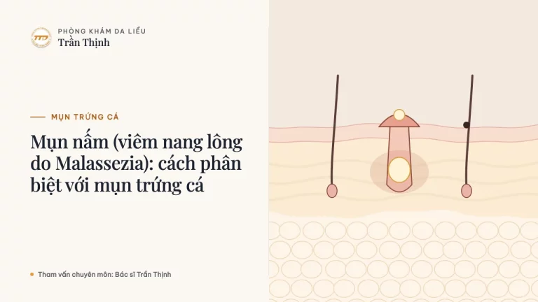 Mụn nấm (viêm nang lông do Malassezia): cách phân biệt với mụn trứng cá