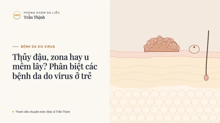 Thủy đậu, zona hay u mềm lây? Phân biệt các bệnh da do virus ở trẻ